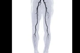 Peripheral Angiography